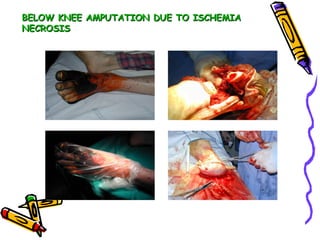 BELOW KNEE AMPUTATION DUE TO ISCHEMIA NECROSIS 