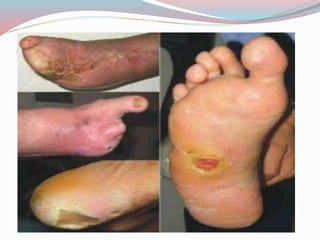 COMPLICAÇÕES
 Descompensação hiperglicêcima aguda;
 Cetoacidose (hálito e odor urêmico);
 Hipoglicemia;
 Doenças cardiovasculares;
 Retinopatia;
 Nefropatia;
 Neuropatia;
 Pé diabético;
 