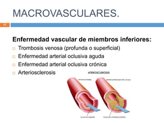 MACROVASCULARES.
17
Enfermedad vascular de miembros inferiores:
 Trombosis venosa (profunda o superficial)
 Enfermedad arterial oclusiva aguda
 Enfermedad arterial oclusiva crónica
 Arteriosclerosis
 