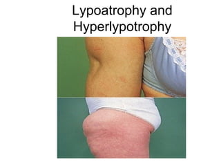 Lypoatrophy and
Hyperlypotrophy
 