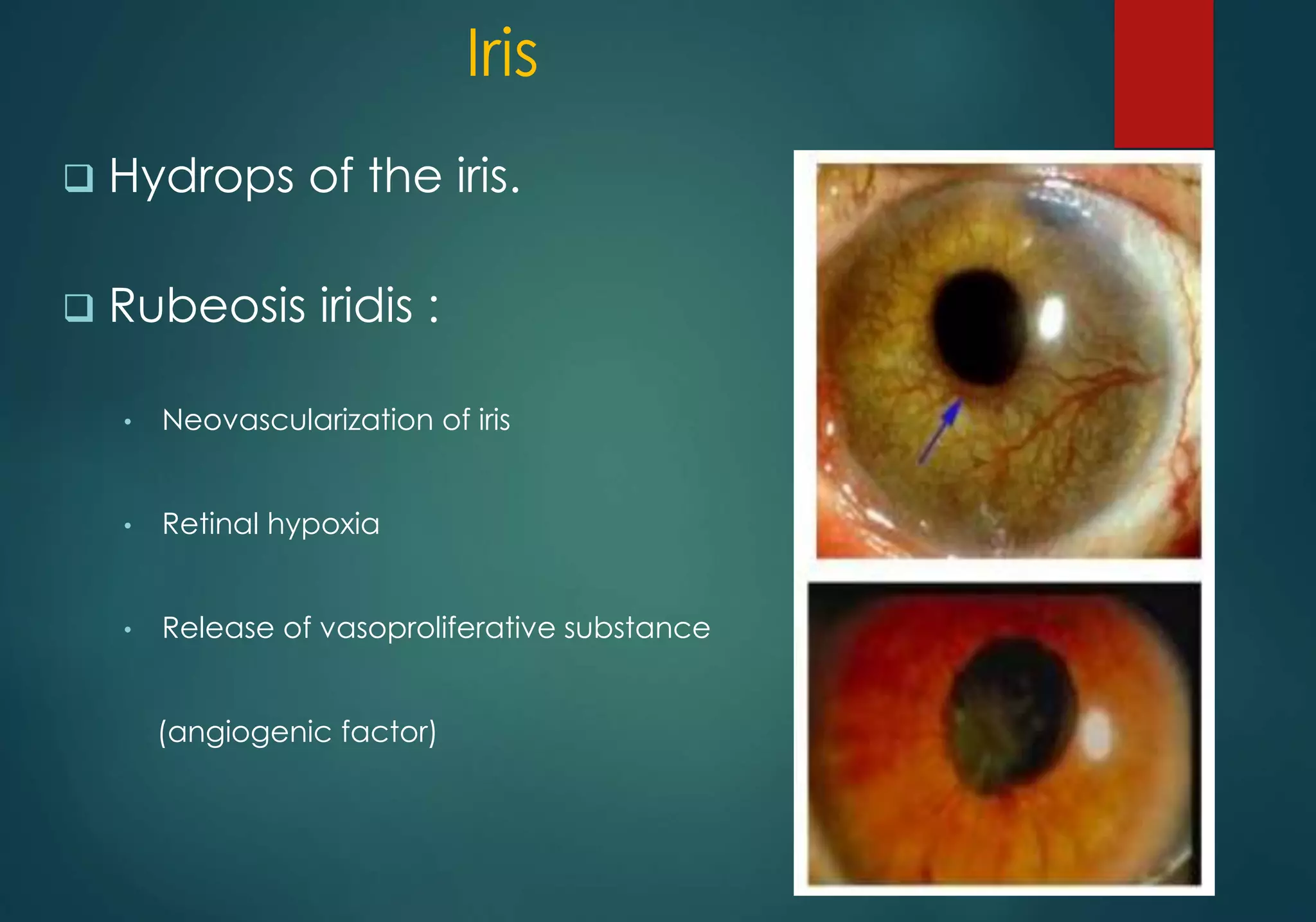 DIABETES AND THE EYE | PPTX
