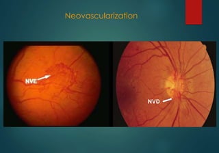 Nvd Optometry DIABETES AND THE EYE | PPTX