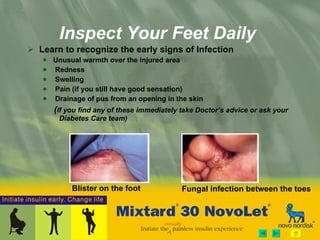 Learn to recognize the early signs of Infection Unusual warmth over the injured area Redness Swelling Pain (if you still have good sensation) Drainage of pus from an opening in the skin   ( If you find any of these immediately take Doctor’s advice or ask your  Diabetes Care team) Inspect Your Feet Daily Fungal infection between the toes Blister on the foot 