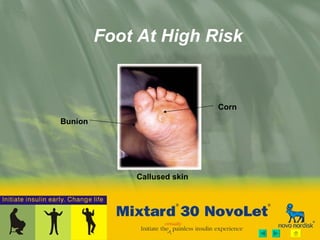 Foot At High Risk Callused skin Bunion Corn 