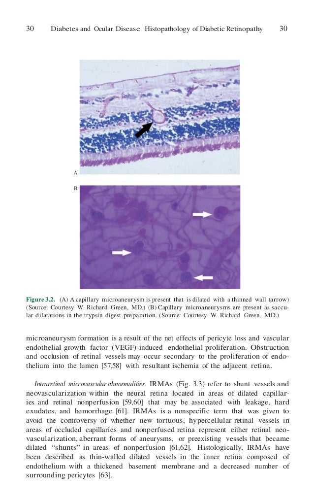 diabetes and ocular disease past present and future therapies 50 638