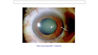 Negative Rubeosis DIABETES AND THE EYE.pptx