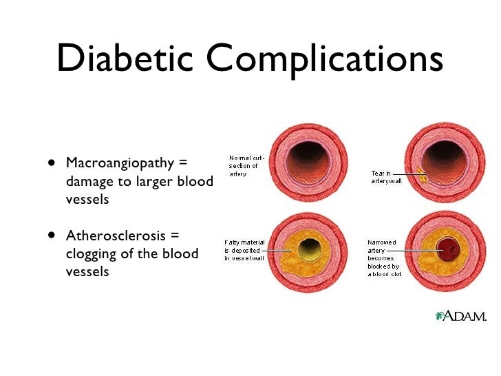 How Diabetes Affects Your Brain Webmd How Diabetes Affects Your Brain Webmd