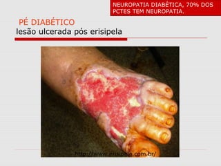 NEUROPATIA DIABÉTICA, 70% DOS
PCTES TEM NEUROPATIA.

PÉ DIABÉTICO
lesão ulcerada pós erisipela

http://www.erisipela.com.br/

 
