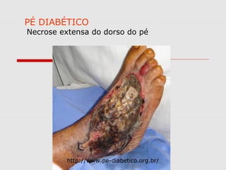 PÉ DIABÉTICO

Necrose extensa do dorso do pé

http://www.pe-diabetico.org.br/

 