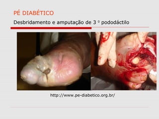 PÉ DIABÉTICO
Desbridamento e amputação de 3

0

pododáctilo

http://www.pe-diabetico.org.br/

 