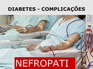 DIABETES - COMPLICAÇÕES

NEFROPATI

 