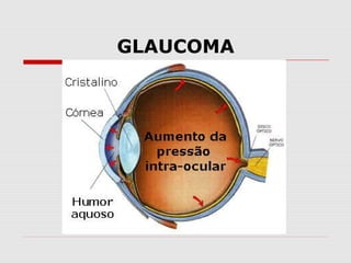 GLAUCOMA

 