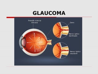 GLAUCOMA

 