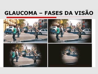 GLAUCOMA – FASES DA VISÃO

 