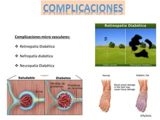 Complicaciones micro vasculares: 
 Retinopatía Diabética 
 Nefropatía diabética 
 Neuropatía Diabética 
 