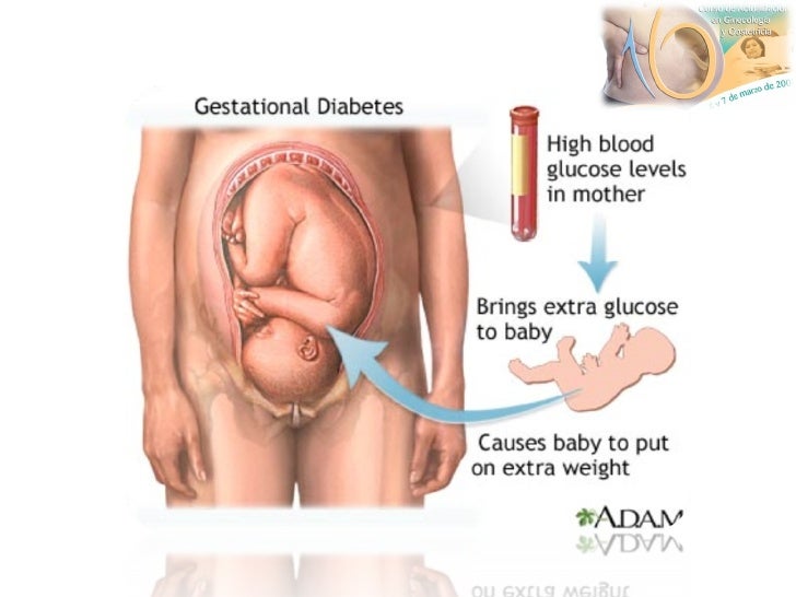 Diabetes gestacional parto