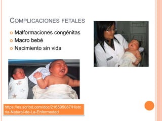 COMPLICACIONES FETALES
 Malformaciones congénitas
 Macro bebé
 Nacimiento sin vida
https://es.scribd.com/doc/216595087/Histo
ria-Natural-de-La-Enfermedad
 