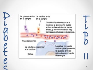 Tip
o
II
Diabete s