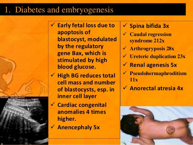 Diabetes in pregnancy