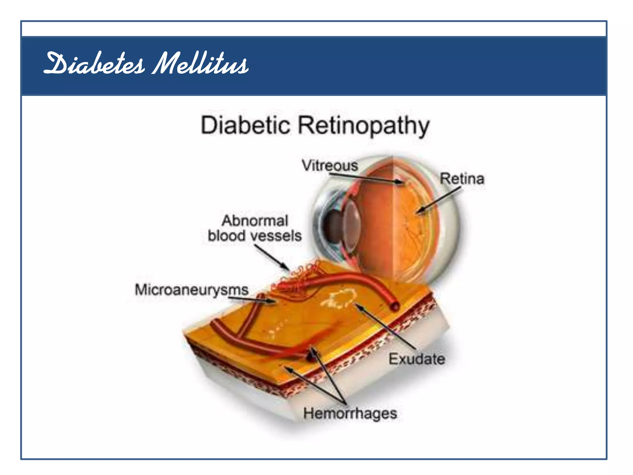 Diabetes Mellitus
 