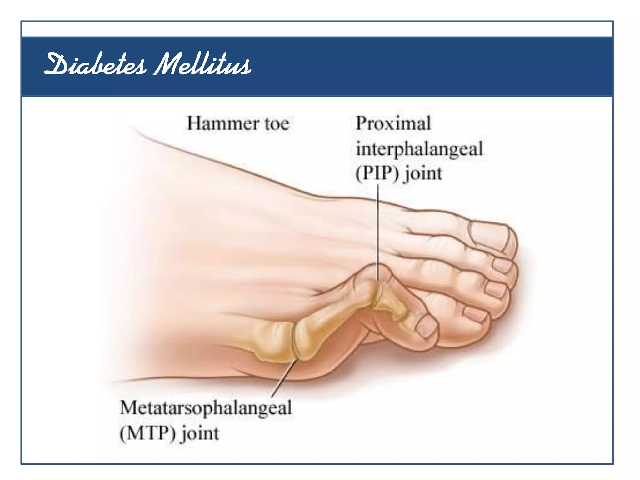 Diabetes Mellitus
 