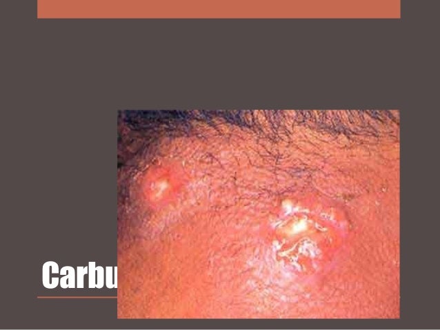 DIABETES MELITUS