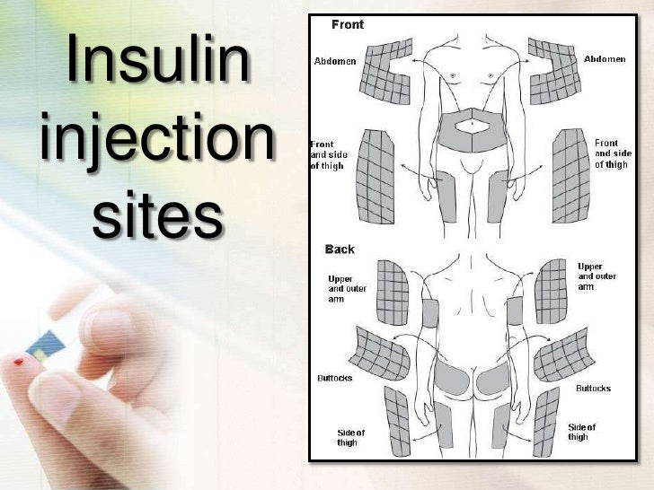 Insulin Injection Rotation Sites Chart