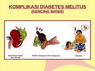 KOMPLIKASI DIABETES MELITUS  (KENCING MANIS) 