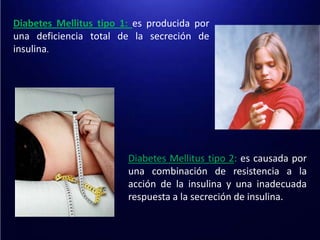 Diabetes Mellitus tipo 1: es producida por una deficiencia total de la secreción de insulina. Diabetes Mellitus tipo 2: es causada por una combinación de resistencia a la acción de la insulina y una inadecuada respuesta a la secreción de insulina.