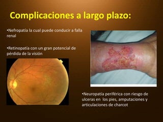 Complicaciones a largo plazo: Nefropatía la cual puede conducir a falla renal