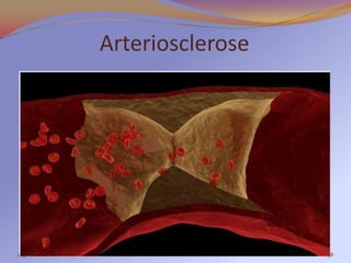 Arteriosclerose




11:30                     36
 