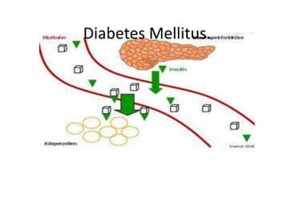 Diabetes Mellitus.
 