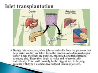  During this procedure, islets (clusters of cells from the pancreas that
help make insulin) are taken from the pancreas of a deceased organ
donor. Then, the islets are purified, processed, and transferred to
someone else. These then begin to make and release insulin
individually. This could possibly be the biggest step in helping
patients with type 1 diabetes live without insulin injections.

 