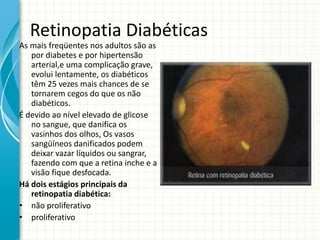 Retinopatia Diabéticas
As mais freqüentes nos adultos são as
por diabetes e por hipertensão
arterial,e uma complicação grave,
evolui lentamente, os diabéticos
têm 25 vezes mais chances de se
tornarem cegos do que os não
diabéticos.
É devido ao nível elevado de glicose
no sangue, que danifica os
vasinhos dos olhos, Os vasos
sangüíneos danificados podem
deixar vazar líquidos ou sangrar,
fazendo com que a retina inche e a
visão fique desfocada.
Há dois estágios principais da
retinopatia diabética:
• não proliferativo
• proliferativo
 