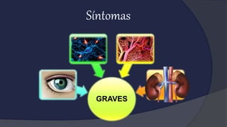 Síntomas
GRAVES
 
