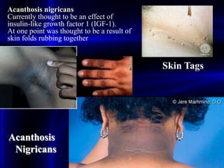 Acanthosis
Nigricans
Skin Tags
Acanthosis nigricans
Currently thought to be an effect of
insulin-like growth factor 1 (IGF-1).
At one point was thought to be a result of
skin folds rubbing together
 