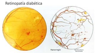 Retinopatía diabética
23/02/2017
Vela Rivera Marcos
Manual Mosby
 