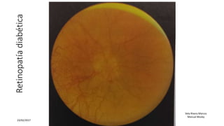 Retinopatíadiabética
23/02/2017
Vela Rivera Marcos
Manual Mosby
 