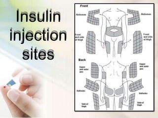Insulin
injection
sites
 