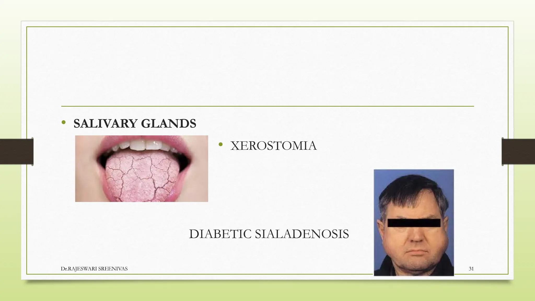 DIABETES MELLITU- types and mechanism of action | PPTX