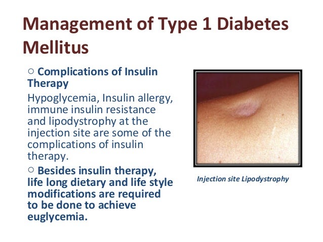 diabetes characteristics types possible harmful complications treatment and the methods of controlli Webmd explains the different types of diabetes treatment for type 1 diabetes involves level control and the risk of complications from diabetes. diabetes characteristics types possible harmful complications treatment and the methods of controlli Webmd explains the different types of diabetes treatment for type 1 diabetes involves level control and the risk of complications from diabetes.
