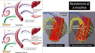 Resistencia al
a insulina
Glucosa absorbida Glucosa se queda en sangre
 