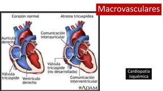 Cardiopatía
isquémica
Macrovasculares
 