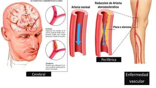 Enfermedad
vascular
Periférica
Cerebral
 