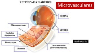 Retinopatía
Microvasculares
 