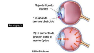 Retinopatía
 