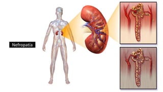 Nefropatía
 