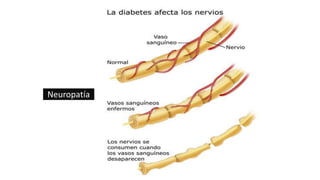 Neuropatía
 