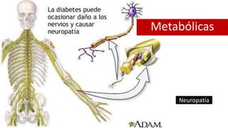 Neuropatía
Metabólicas
 