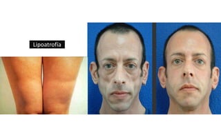 Lipoatrofía
 